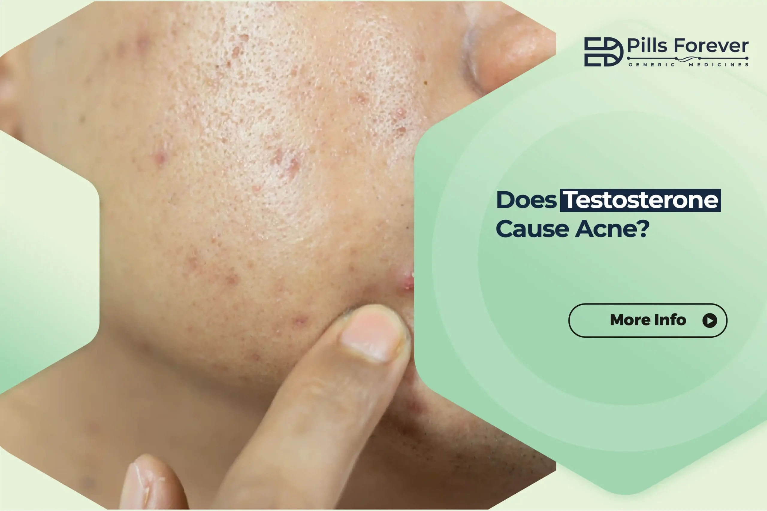 Does Testosterone Cause Acne? Breaking It Down Without Overcomplicating It