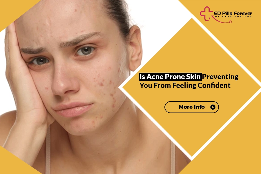 Young woman struggling with acne prone skin and facial blemishes while looking worried