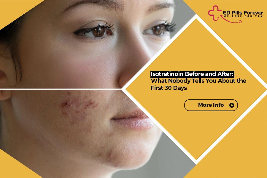 Split image of woman's face showing clear skin and acne scarring, with text "Isotretinoin Before and After: What Nobody Tells You About the First 30 Days"