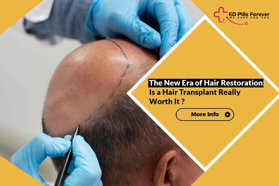 The New Era of Hair Restoration- Is a Hair Transplant Really Worth It
