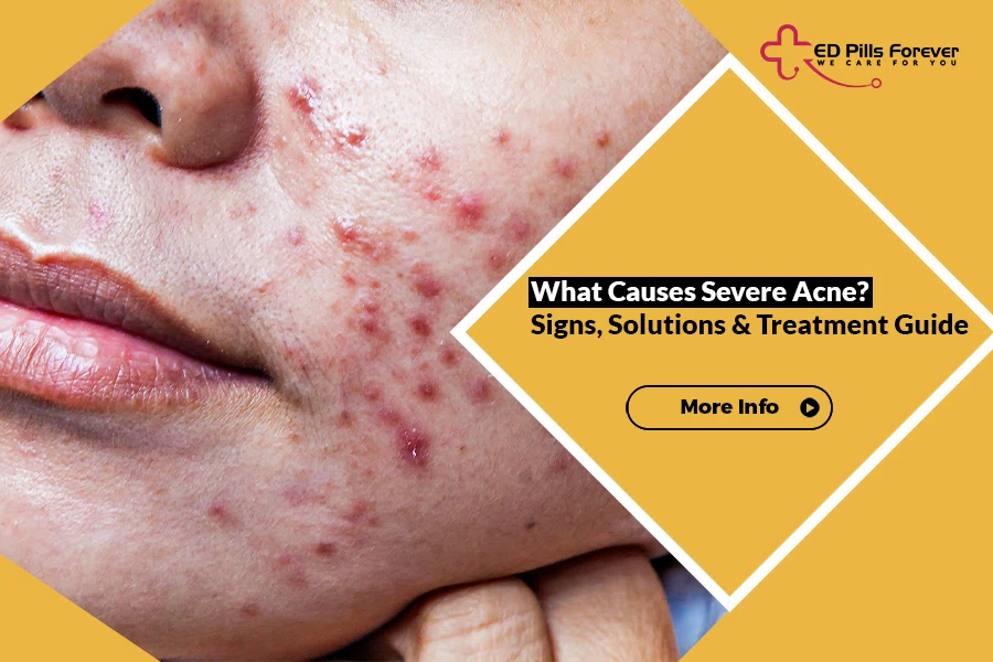 Severe acne causes and treatment guide