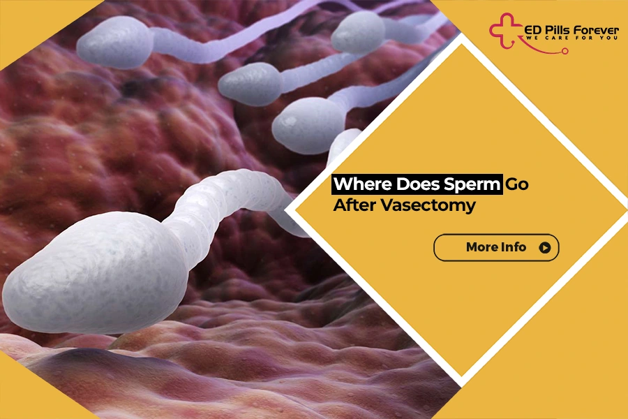 Where Does Sperm Go After Vasectomy